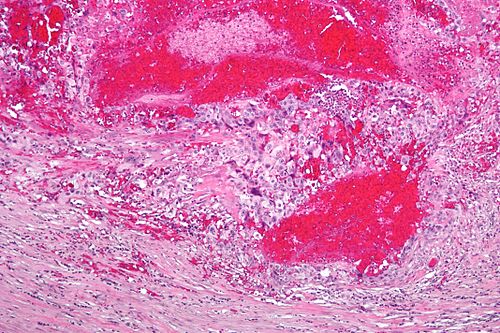 Choriocarcinoma - intermed mag.jpg