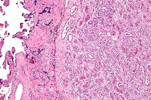 Chorangioma - intermed mag.jpg