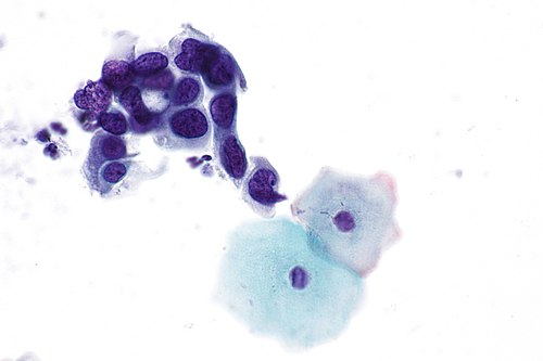 High-grade squamous intraepithelial lesion - 4 -- very high mag.jpg