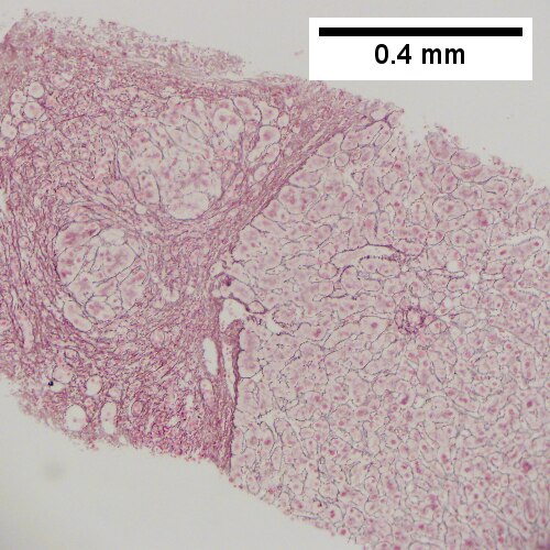 Alcoholic hepatitis with Metavir stage IV fibrosis (advanced fibrosis/cirrhosis).