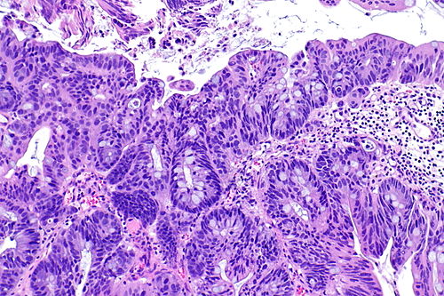 Adenocarcinoma of the urinary bladder -- intermed mag.jpg