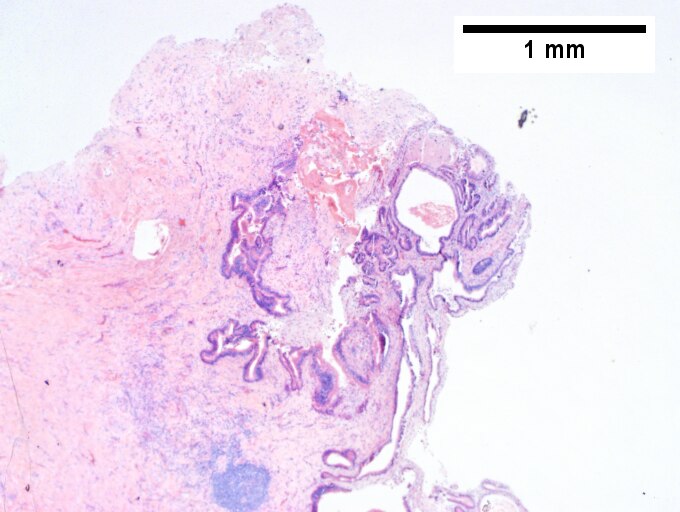 Intraductal papillary neoplasm of common bile duct with associated invasive carcinoma.