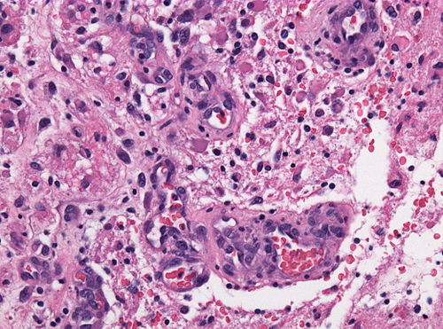 Neuropathology case IX 03.jpg