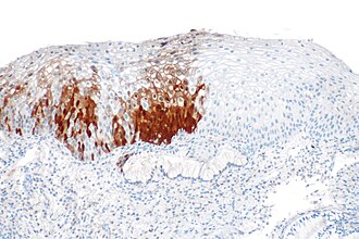 p16 IHC