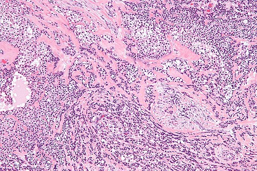 Hyalinizing clear cell carcinoma - intermed mag.jpg