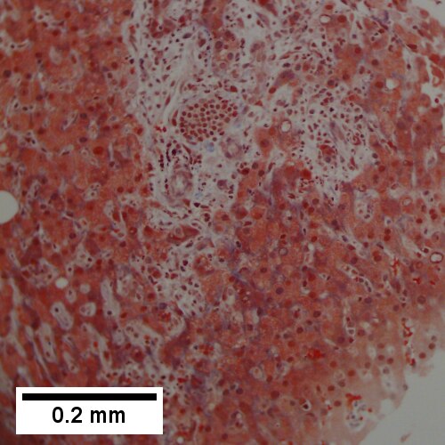 Trichrome shows collagenization of spaces of Disse. Scarring about an abscess or other mass lesion should not be interpreted as reflective of the liver in general (200X).