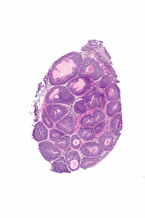 Cystitis cystica -- low mag.jpg