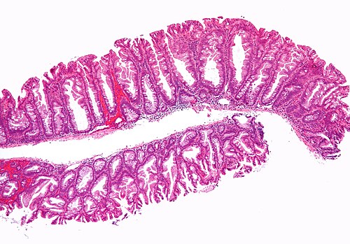 Sessile serrated adenoma 2 low mag.jpg