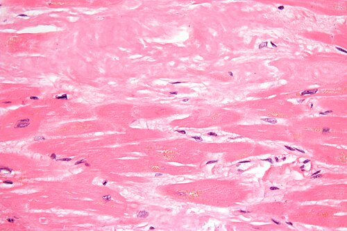 Cardiac amyloidosis very high mag he.jpg