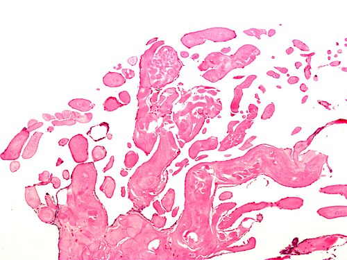 Papillary fibroelastoma.jpg