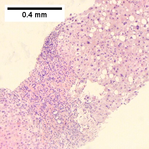 Alpha 1 Antitrypsin deficiency with cirrhosis