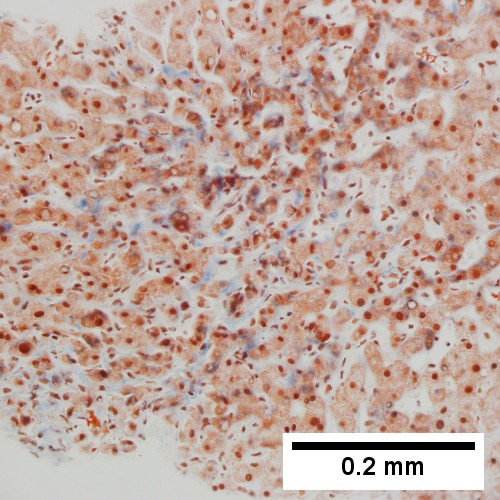 Trichrome shows space of Disse collagenization (pericellular fibrosis) (200X).