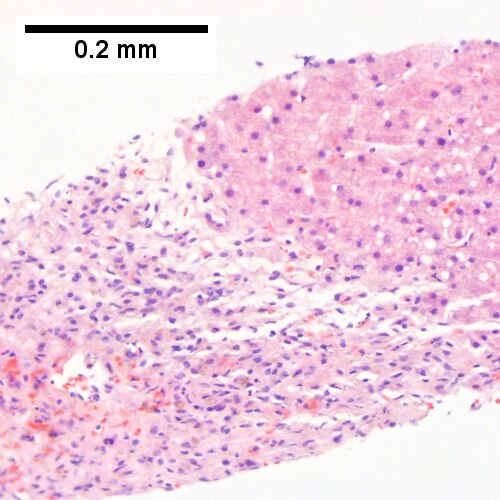 Submassive hepatic necrosis.