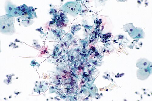 Candida - Pap test -- high mag.jpg