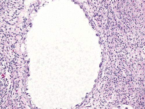 High magnification of tubulocystic clear cell carcinoma of ovary.jpg
