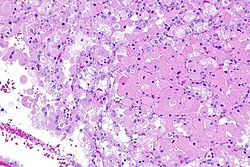 Eosinophilic, solid and cystic renal cell carcinoma - 3 -- intermed mag.jpg