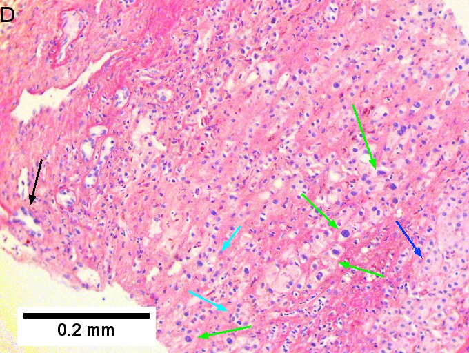 Cholangiocarcinoma with associated abscess