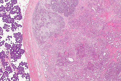 Carcinoma ex pleomorphic adenoma -- very low mag.jpg