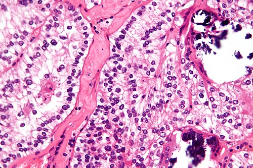 Xp11.2 translocation renal cell carcinoma - very high mag.jpg