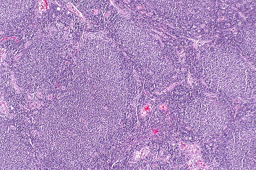 Patient's tissue