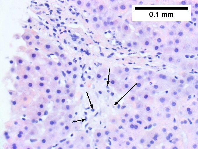 Primary sclerosing cholangitis in patient with history of ulcerative colitis.