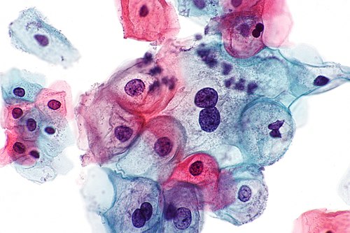 Low-grade squamous intraepithelial lesion - 2 -- very high mag.jpg