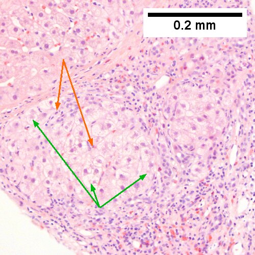 Alcoholic hepatitis with Metavir stage IV fibrosis (advanced fibrosis/cirrhosis).