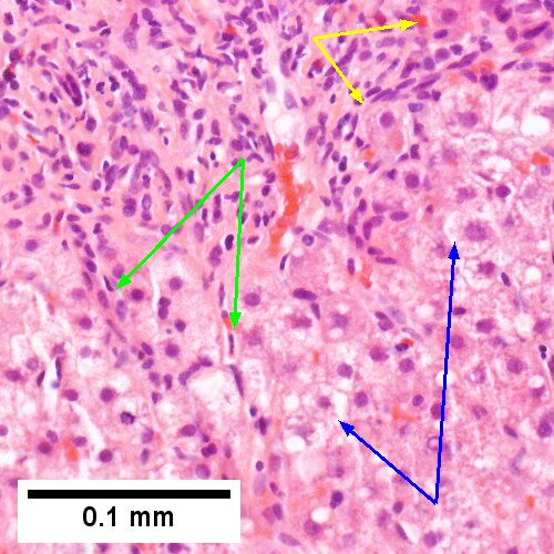 Hepatitis C. Metavir Activity Index 2 (PMN2, LN1), Metavir fibrosis stage 3