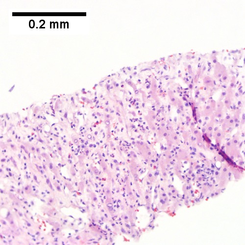 Neutrophils lie in widened sinusoids (200X)..