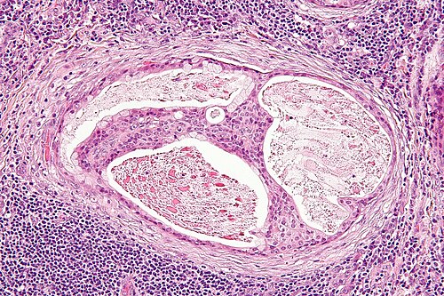 Mucoepidermoid carcinoma - 2 - high mag.jpg