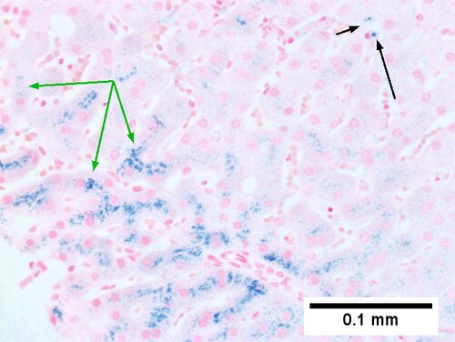 Hemocrhomatosis with DILI canalicular cholestasis with mild hepatocyte injury in the form of regeneration.