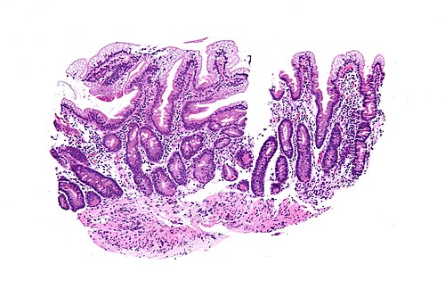 Abetalipoproteinemia - intermed mag.jpg