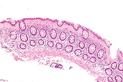 Collagenous colitis - intermed mag.jpg