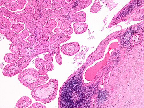 Papillary cystadenoma lymphomatosum2.jpg