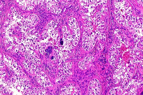 Translocation carcinoma - kidney -- intermed mag.jpg
