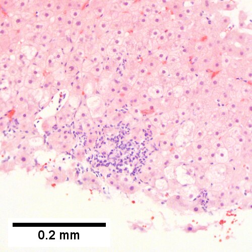 Alcoholic hepatitis with Metavir stage IV fibrosis (advanced fibrosis/cirrhosis).