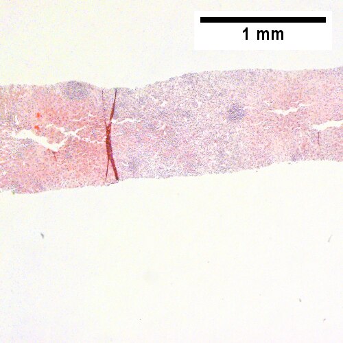 Apparent inflamed fibrous band between two relatively hepatocyte regions (Row 1 Right 40X).
