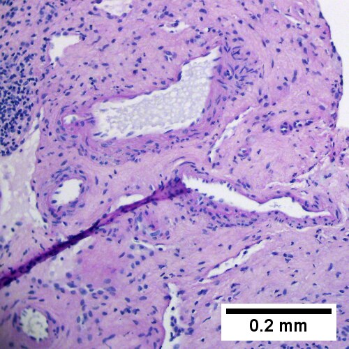 PAS-D shows proliferated blood vessels in center of scar with minimal inflammation (200X).