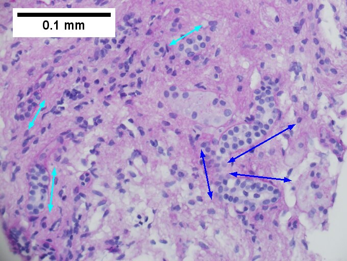 Cirrhosis in an alcoholic.