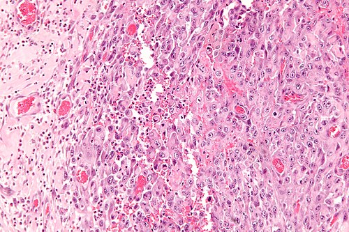 Epithelioid sarcoma - high mag.jpg