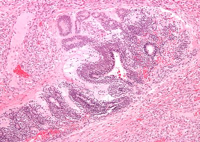 Primitive neuroepithelium intermed mag.jpg