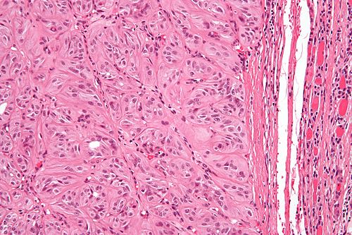 Hyalinized trabecular tumour - high mag.jpg