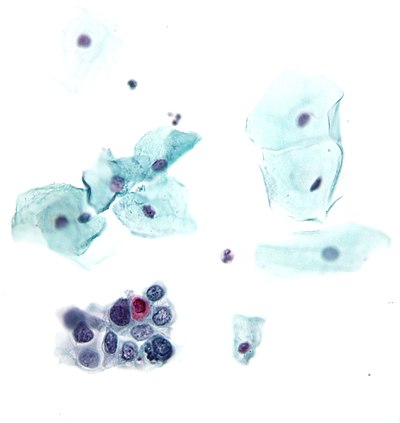 High-grade squamous intraepithelial lesion.jpg