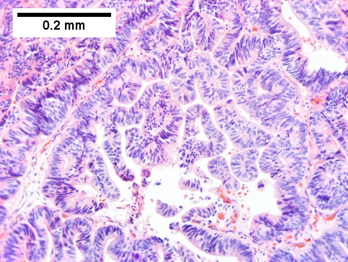 Intraductal papillary neoplasm of common bile duct with associated invasive carcinoma.