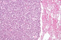 Lung carcinoid - low mag.jpg