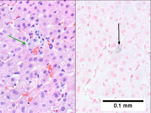 Hemocrhomatosis with DILI canalicular cholestasis with mild hepatocyte injury in the form of regeneration.
