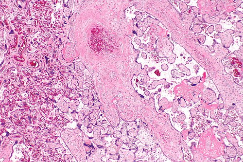 Fetal thrombotic vasculopathy -- low mag.jpg