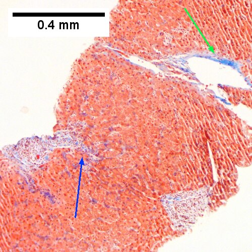 Hepatitis C virus. Metavir Activity Index 1 (PMN 0 LN 1).