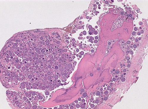 NP psammomatous meningioma 0001.jpg