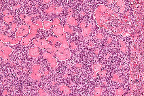 Sex cord tumour with annular tubules - high mag.jpg